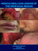 Vesiculobullous Lesions of the Orofacial Region