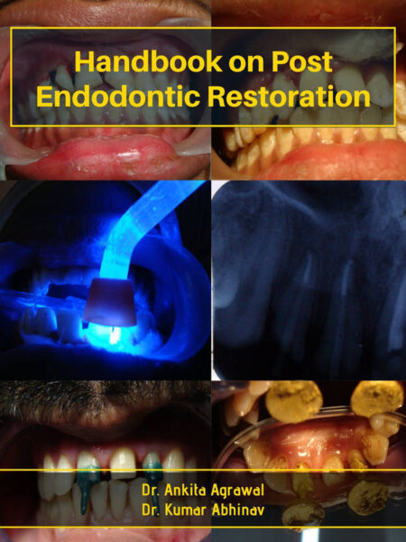 Handbook on Post Endodontic Restoration